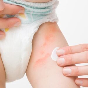 بثورات پوشک چیست؟ بررسی علائم، دلایل و راهکارهای درمان | نی‌نی‎جو